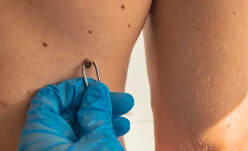 Are Skin Tags Contagious? The Hidden Reasons They Appear