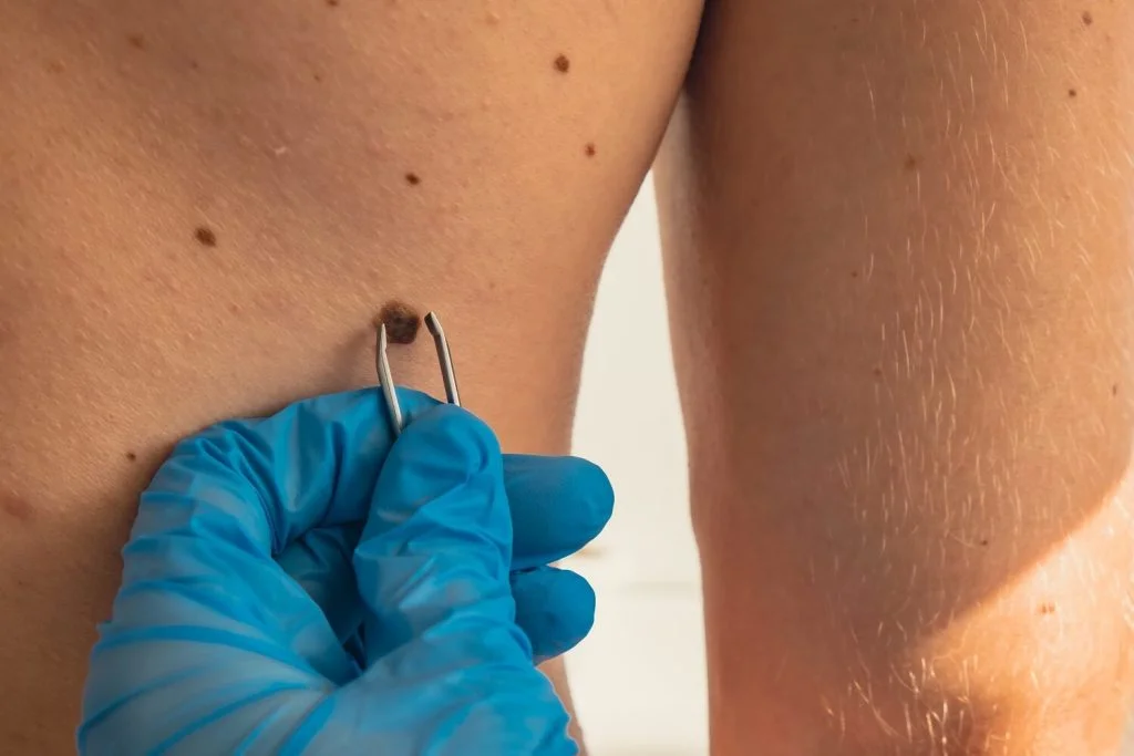 Are Skin Tags Contagious? The Hidden Reasons They Appear