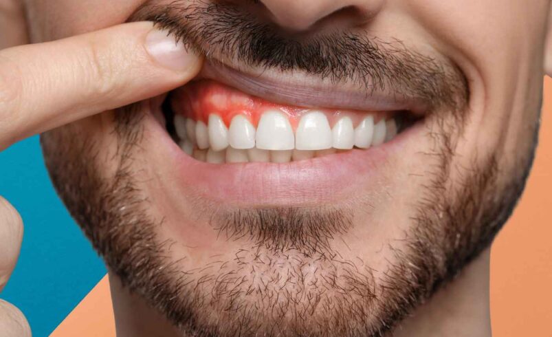 How Long Should a Tooth Abscess Stay Swollen?