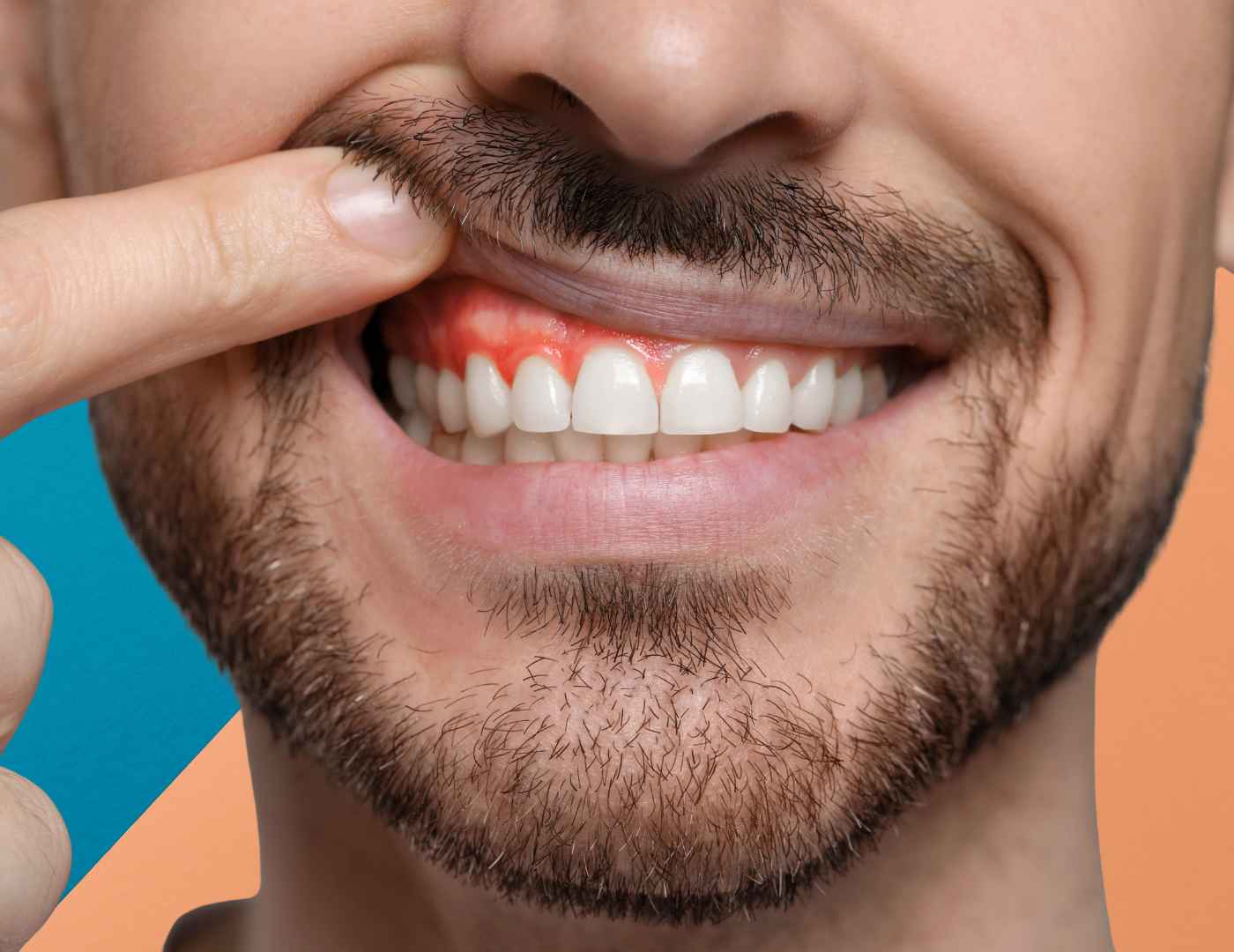 Tooth Abscess Still Swollen