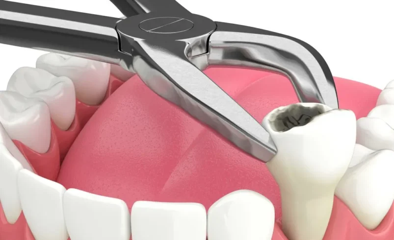 Common Reasons Dentists Recommend Tooth Extraction