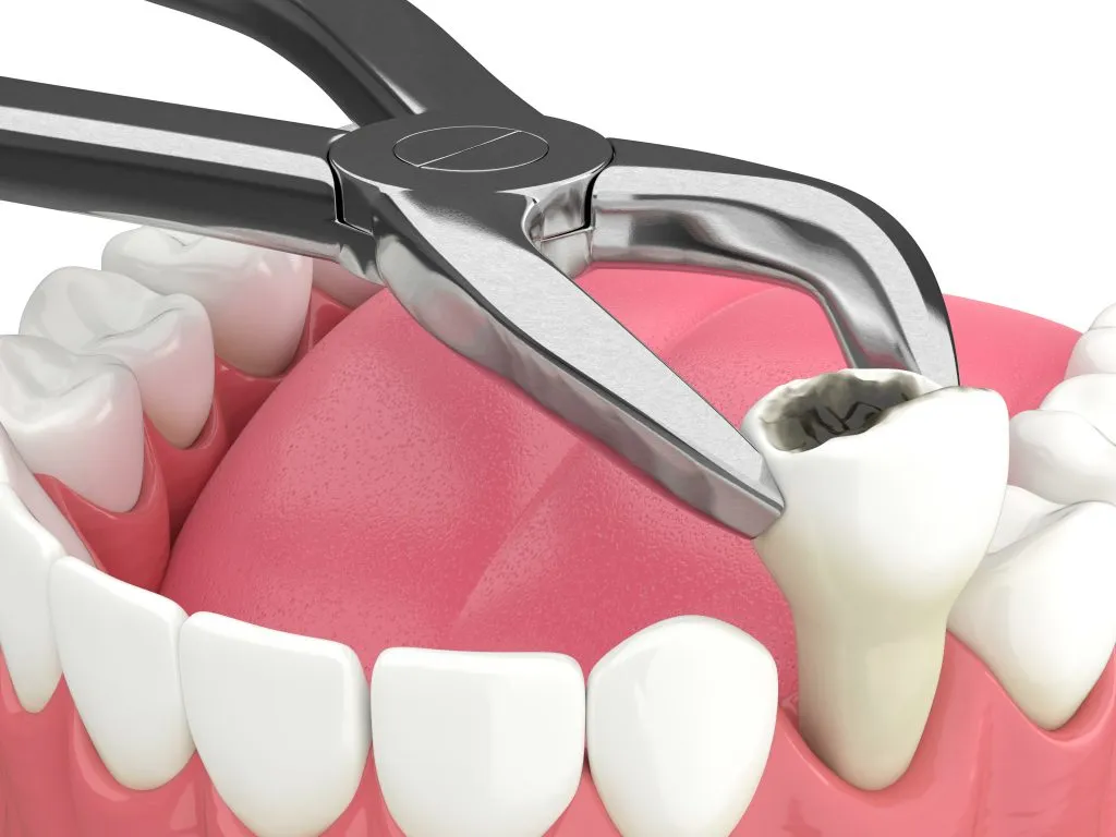 Tooth-Extraction